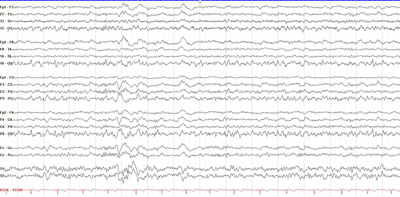 Vertex waves II